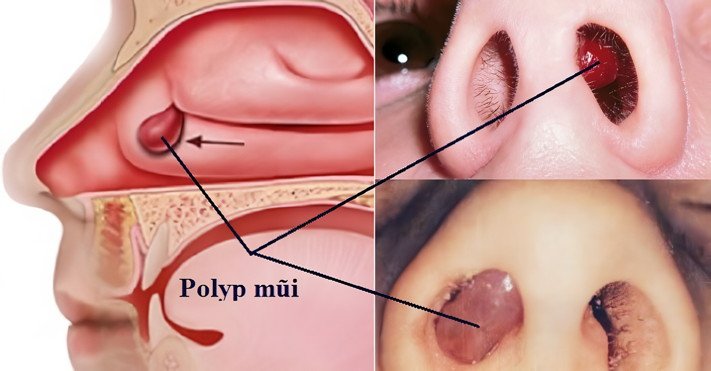 Tuy không gây ung thư nhưng việc mũi có polyp sẽ chèn vào đường thở