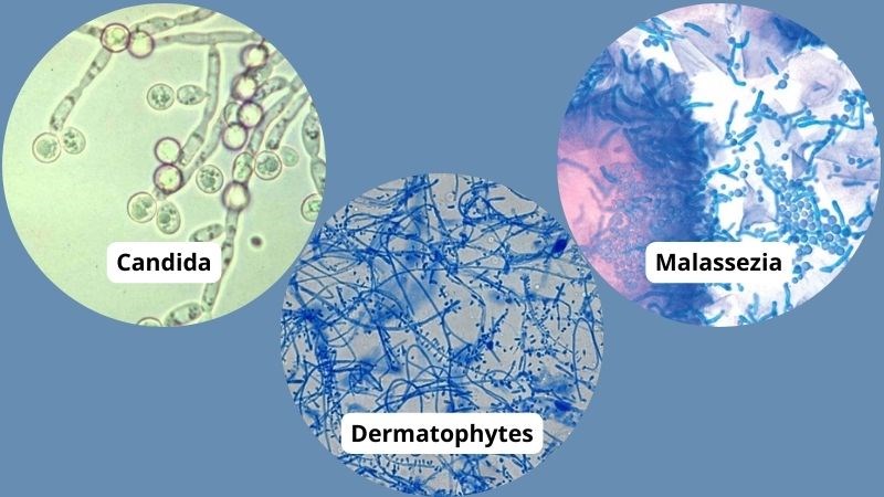 Khuẩn Malassezia - tác nhân chính gây ra phản ứng viêm và bong tróc da đầu.