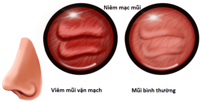 Viêm nhiễm làm mạch máu giãn nở và tiết dịch nhiều hơn bình thường.