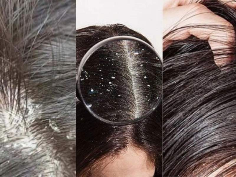 Xác định đúng loại gàu giúp chọn phương pháp điều trị phù hợp.