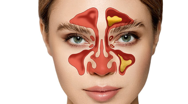 Bệnh không tự khỏi nếu không điều trị, dễ biến chứng viêm xoang hoặc polyp mũi.