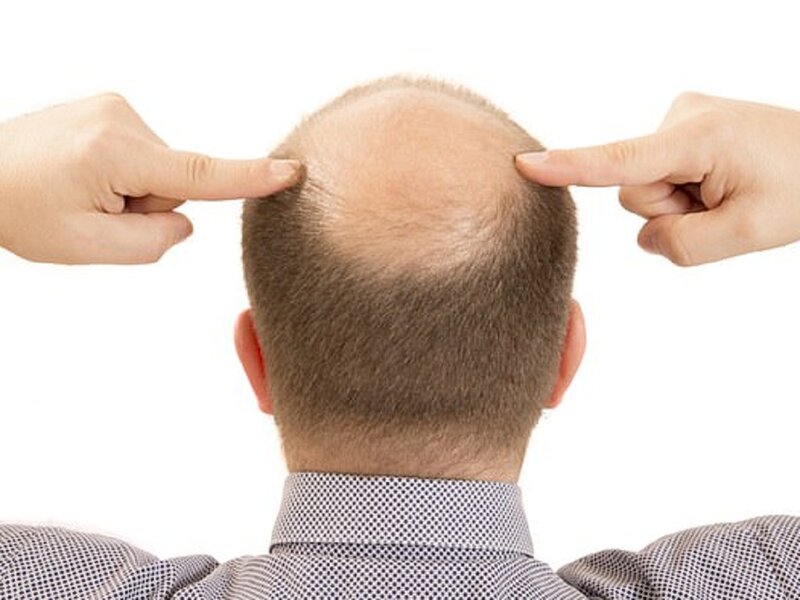 Hói đầu tiến triển khi nang tóc yếu dần và sợi tóc trở nên mảnh, thưa.
