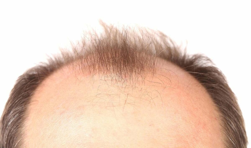 Hói đầu ở nam thường tiến triển theo mô hình chữ M hoặc chữ U.