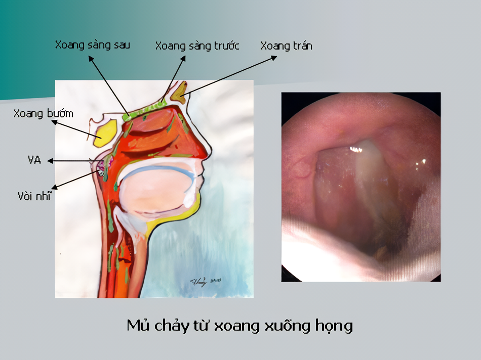 Viêm mũi dị ứng xảy ra khi cơ thể phản ứng quá mức với các tác nhân vô hại như phấn hoa, bụi, lông thú.