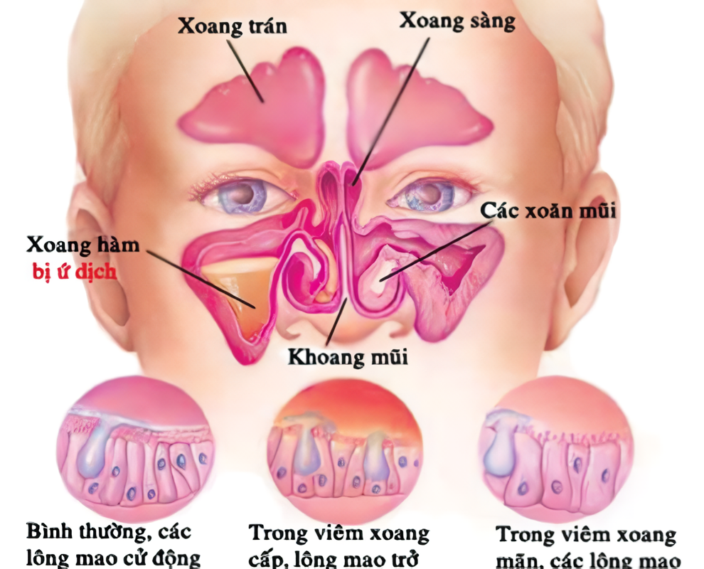 Cơ chế sinh bệnh xoang mũi dị ứng trong khoang mũi