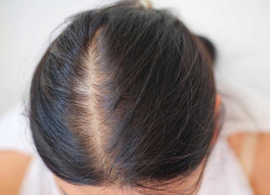 Rụng tóc sau sinh khiến nhiều chị em lo lắng