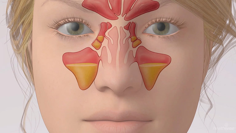 Mỗi xoang có thể viêm riêng hoặc lan tỏa, gây đau nhức và nghẹt mũi khó chịu.