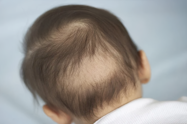 Rụng tóc là dấu hiệu nấm da đầu ở trẻ