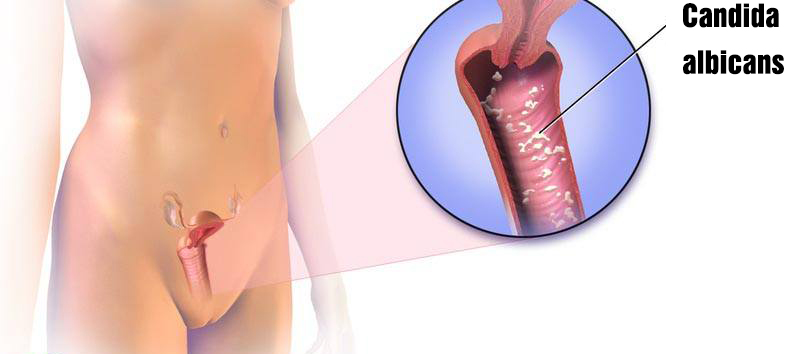 kinh-nghiem-chua-nam-candida-2