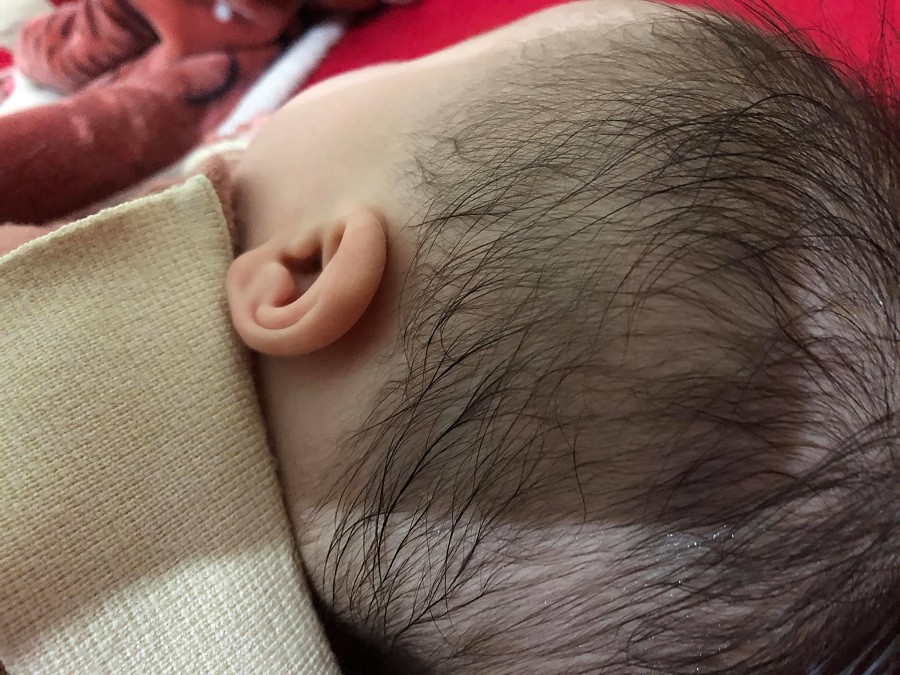 Để tóc ướt đi ngủ dẫn đến tình trạng viêm nấm da đầu ở trẻ em