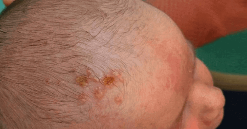 Với các tình trạng viêm nấm da đầu nặng cần điều trị bằng thuốc bôi theo chỉ dẫn