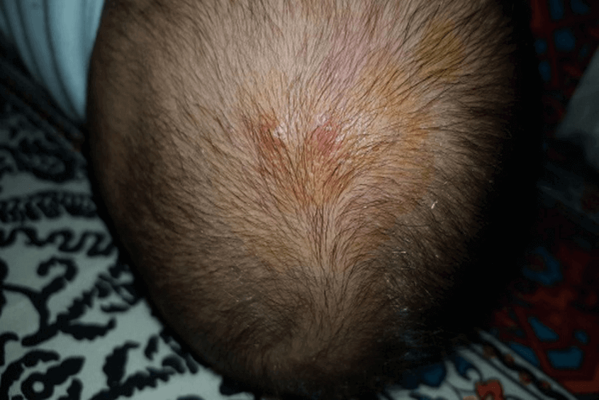 Nấm xâm nhập khiến da đầu của bé xuất hiện các mảng gàu hoặc sưng đỏ