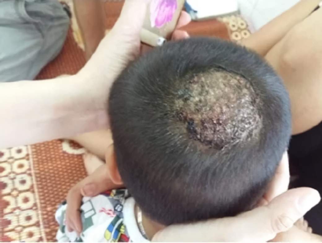 Nấm da đầu ở trẻ nếu không được phát hiện kịp thời có thể phá hủy nang tóc