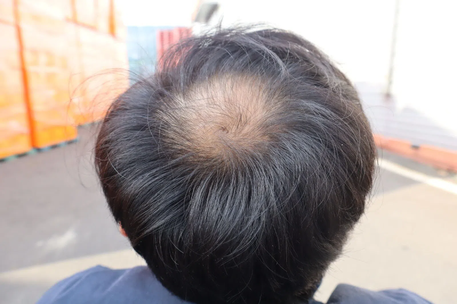 Rụng tóc ở nam gây hoang mang cho bệnh nhân