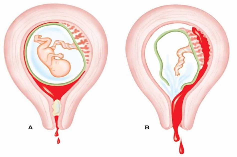 tri-hoi-vung-kin-sau-sinh-2