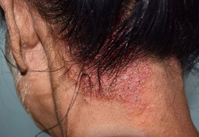 Việc kiêng cữ cẩn thận chế độ ăn uống có thể giúp tình trạng viêm da đầu nhanh phục hồi hơn