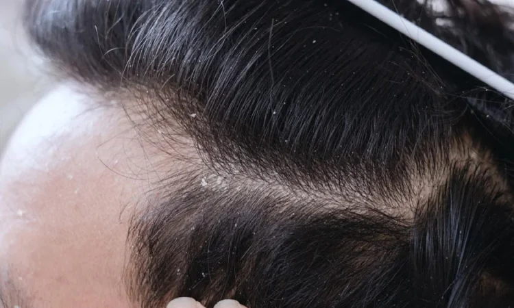 Da đầu có vảy trắng đôi khi chỉ là dấu hiệu của việc mất cân bằng nhẹ