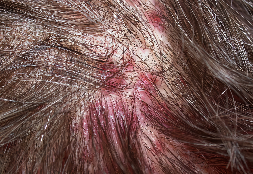 Da đầu mẩn đỏ rất có thể là dấu hiệu bị viêm gây cảm giác đau rát