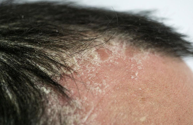 Các dấu hiệu đặc trưng của tình trạng viêm da đầu như vảy gàu và đỏ da.