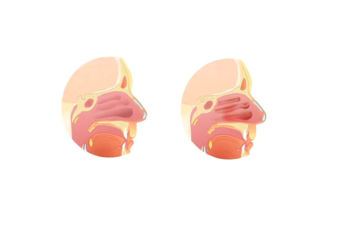 Niêm mạc mũi phù nề, tăng tiết dịch là nền tảng khiến viêm mũi mãn tính kéo dài và dễ tái phát.