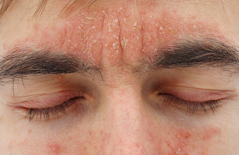 Nấm Malassezia đóng vai trò chủ chốt trong cơ chế viêm da tiết bã.