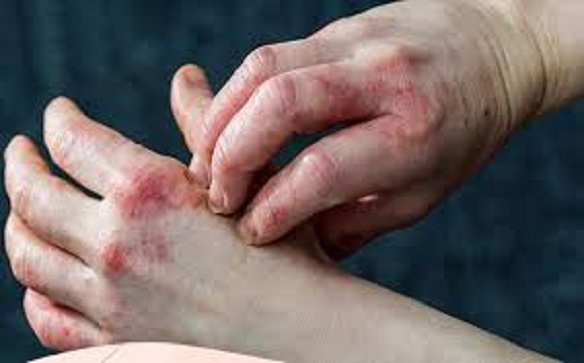 benh-dai-thao-duong-3