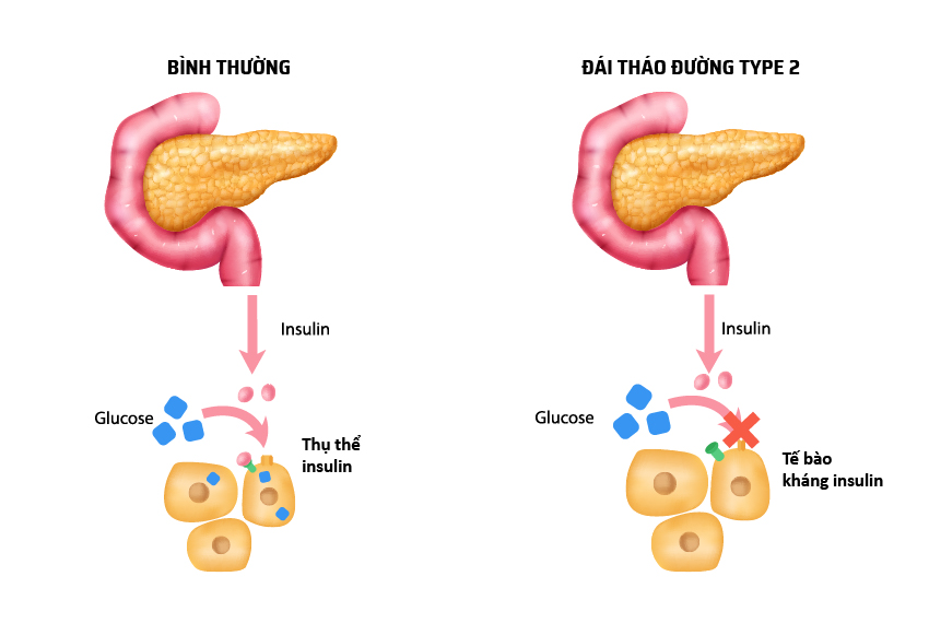 benh-dai-thao-duong-type-2-1