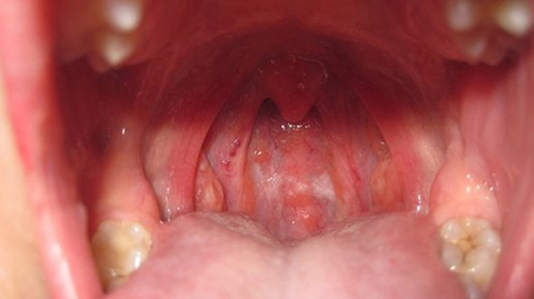 1 cach-het-ho-ngua-co-1