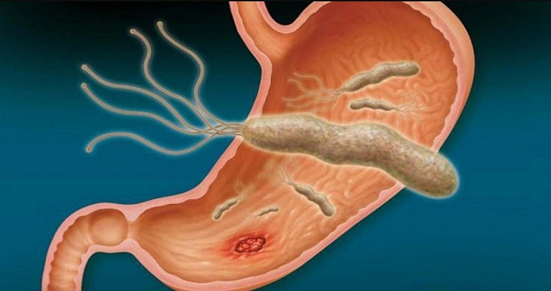 dieu-tri-hp-da-day-o-tre-em-1