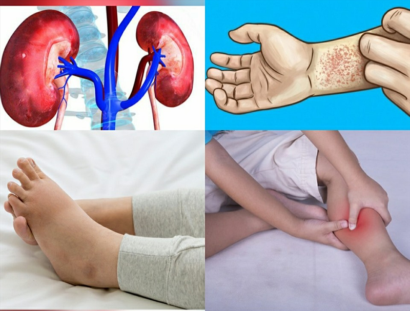 nhung-bien-chung-cua-benh-tieu-duong-1