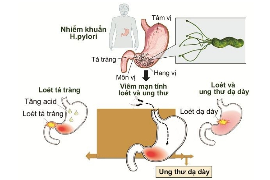vi-khuan-hp-da-day-co-lay-khong-4