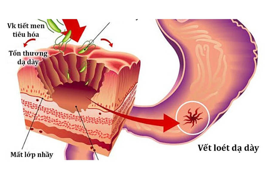 viem-da-day-hp-duong-tinh-3