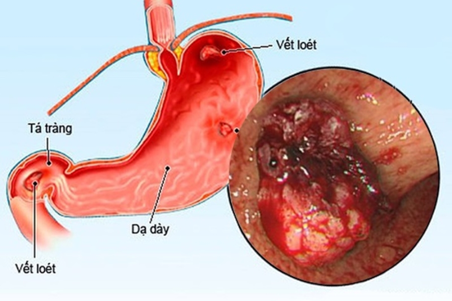 viem-loet-da-day-ta-trang-3