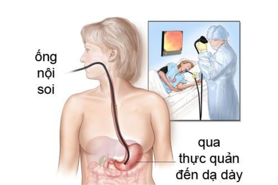 xet-nghiem-hp-da-day-2