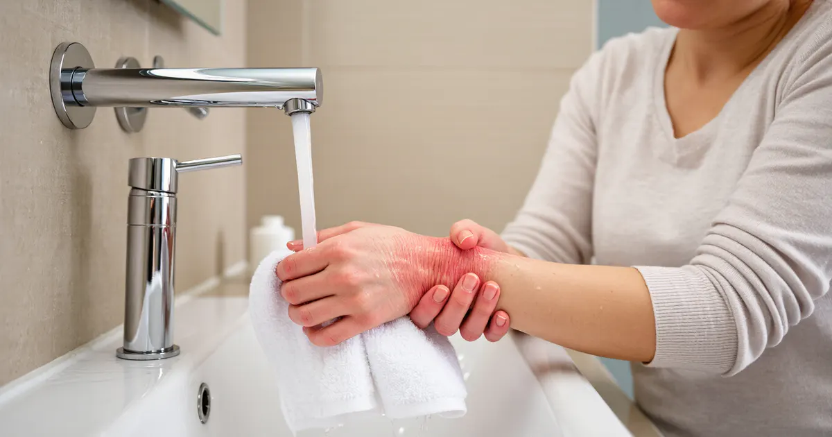 Chăm sóc vùng da dị ứng tiếp xúc bằng cách rửa nhẹ và lau khô