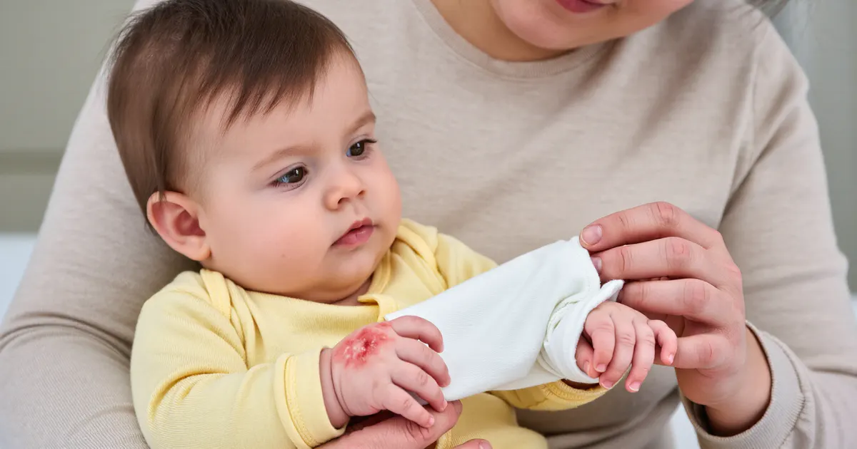 Em bé mặc tay áo cotton mềm giúp hạn chế gãi vùng da kích ứng