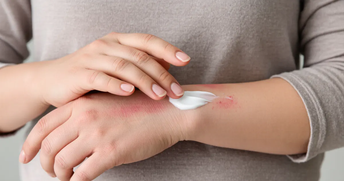 Bàn tay bôi một lớp kem mỏng lên vùng da bị kích ứng nhẹ theo hướng dẫn