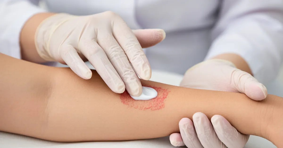 Minh họa cách bôi lớp mỏng thuốc lên vùng da viêm dị ứng ở cẳng tay