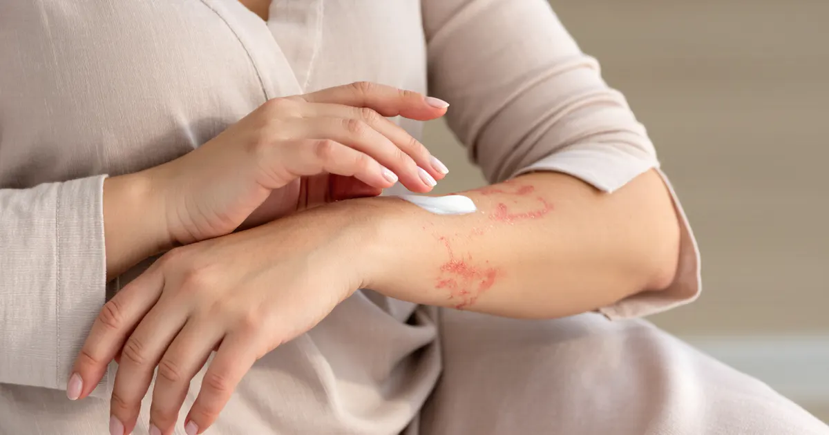 Người chăm sóc vùng da khô ngứa do viêm da cơ địa dị ứng bằng kem dưỡng ẩm