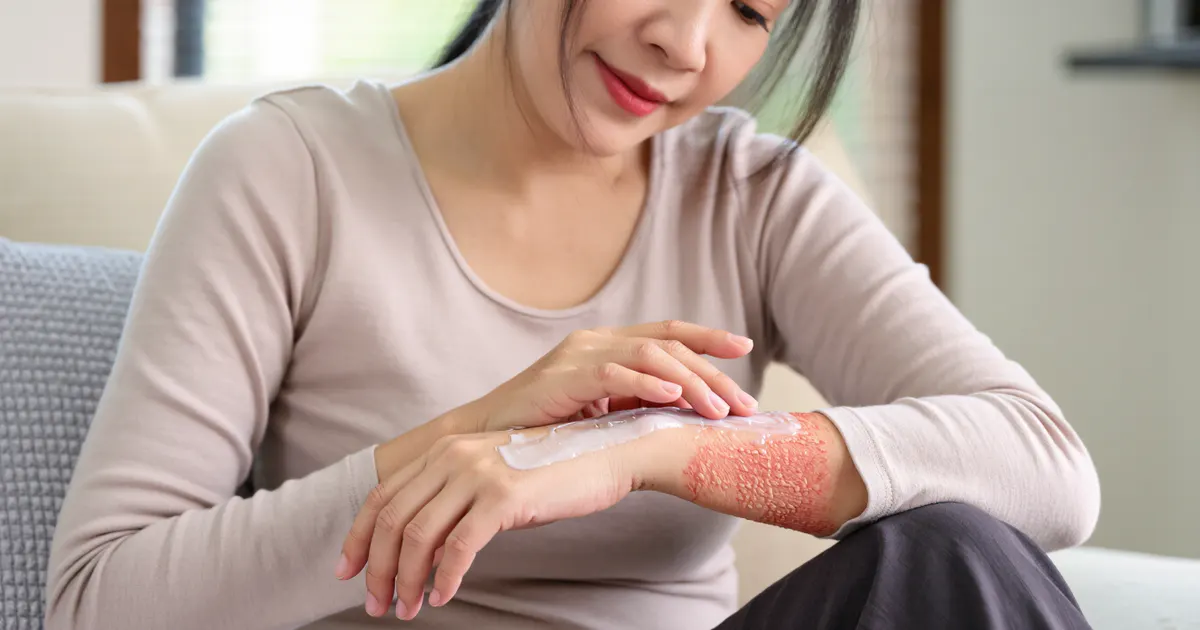 Người bệnh chăm sóc vùng da khô ngứa do viêm da cơ địa nặng tại nhà