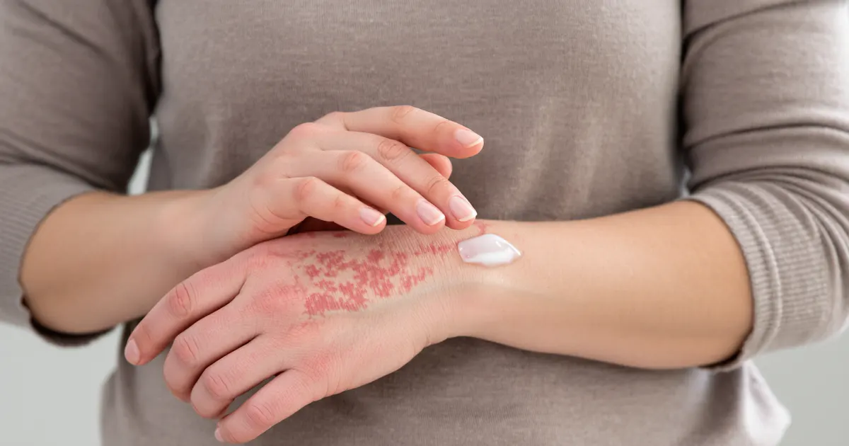 Cận cảnh người chăm sóc vùng da khô ngứa do viêm da cơ địa