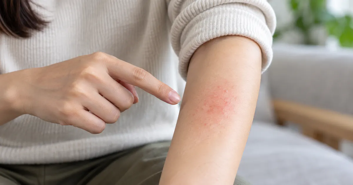 Viêm da tiếp xúc có lây không và cách nhận biết dấu hiệu trên da
