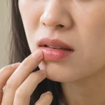 Cận cảnh người chăm sóc đôi môi khô đỏ do viêm môi dị ứng
