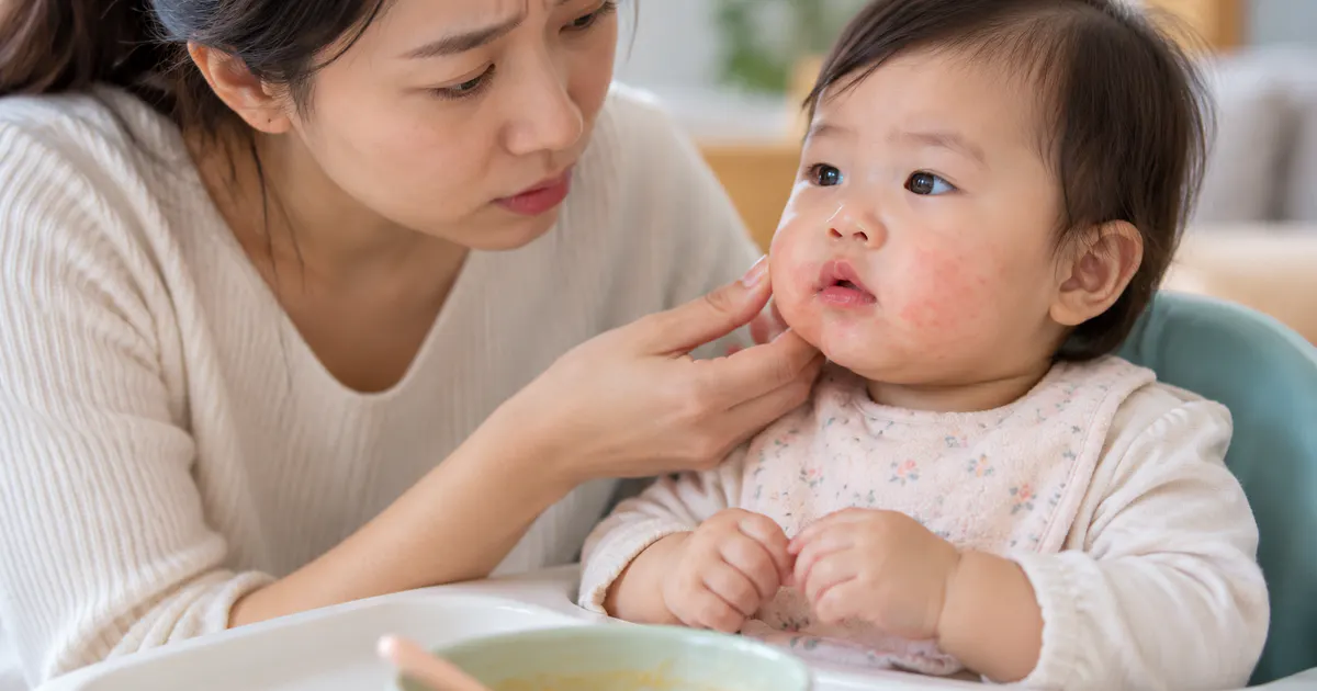 Bé ăn dặm bị dị ứng phải làm sao khi cha mẹ theo dõi phản ứng an toàn