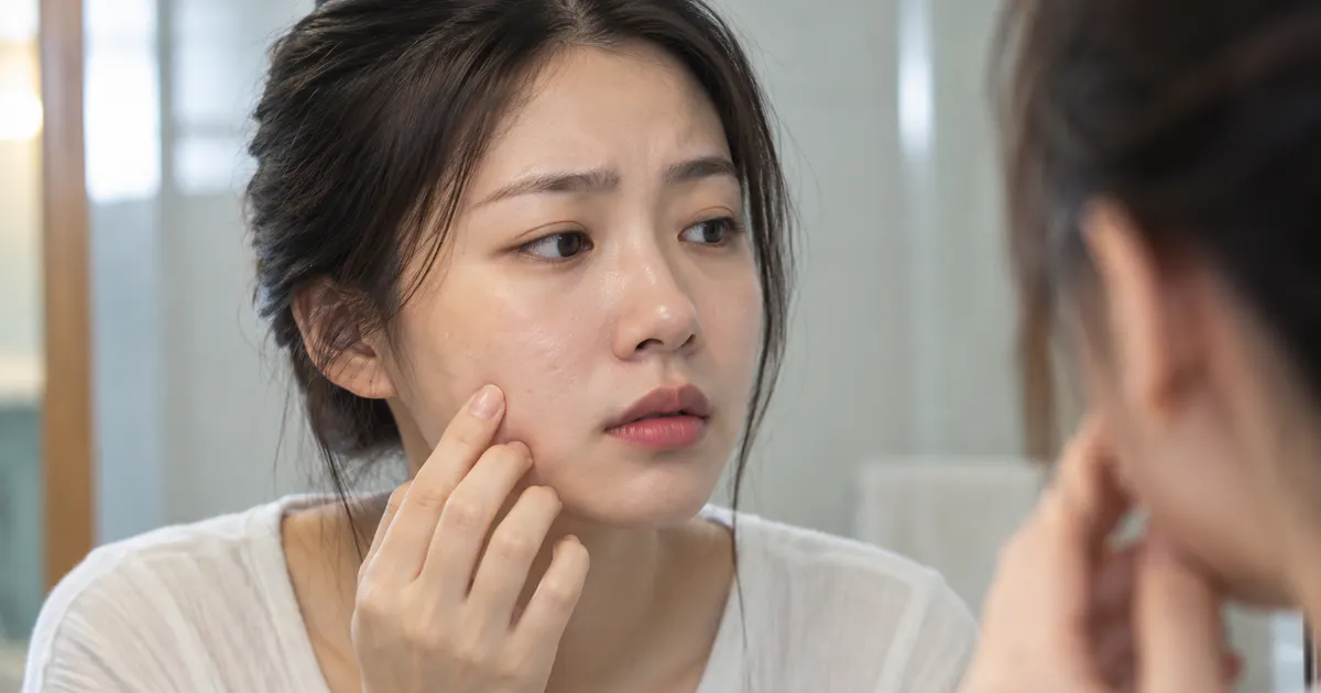 mụn ẩn do dùng mỹ phẩm có xử lý thế nào: người dùng rà soát routine chăm sóc da dịu nhẹ