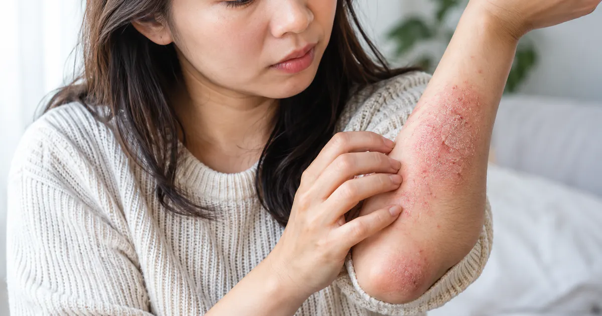 Người trưởng thành chăm sóc vùng da bị viêm da cơ địa nặng ở cánh tay