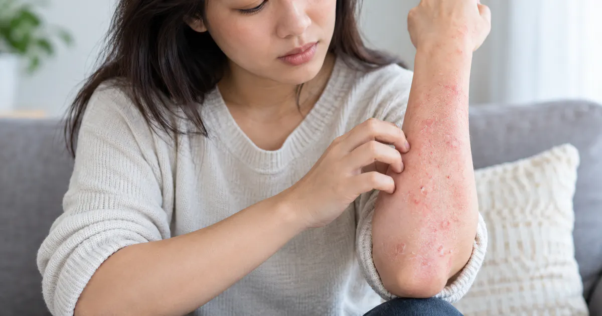 Người bệnh nhận biết vùng da viêm đỏ và ngứa có dấu hiệu trở nặng
