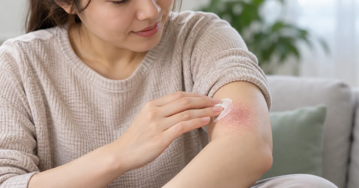 Người phụ nữ chăm sóc vùng da khô ngứa do viêm da cơ địa nhẹ tại nhà