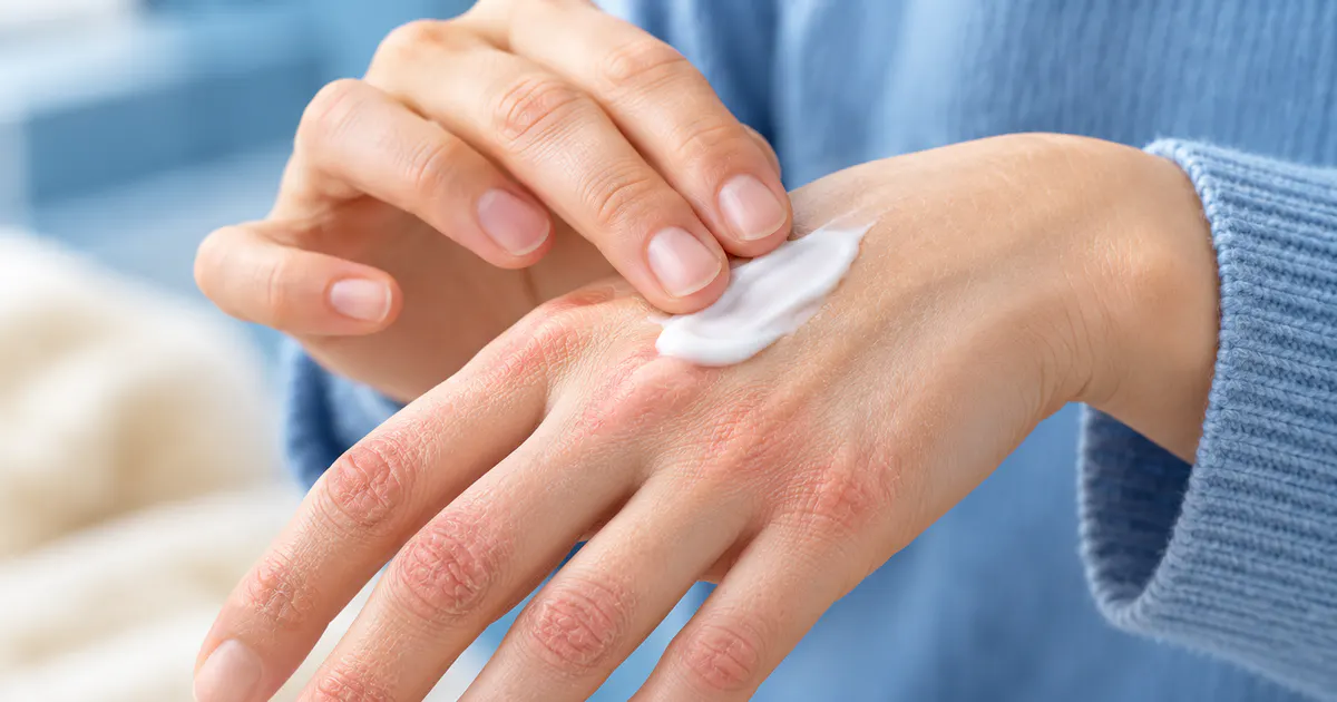 Minh họa chăm sóc và dưỡng ẩm da tay bị khô