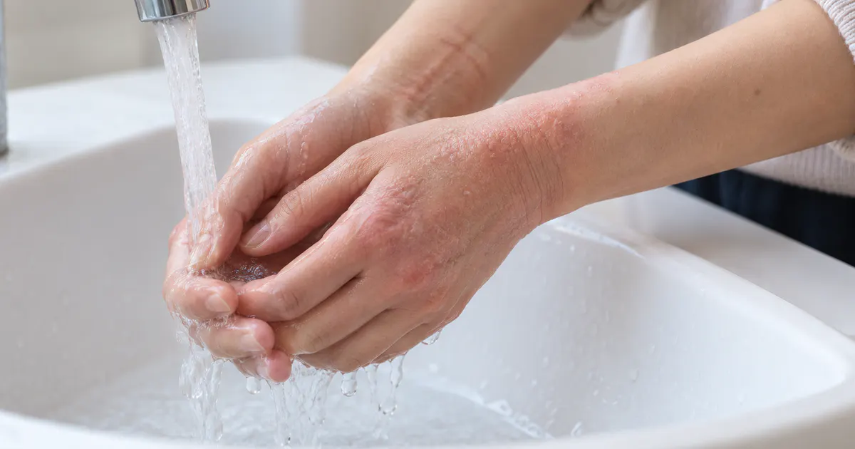 Rửa tay nhẹ nhàng để tránh làm tổn thương da nặng hơn